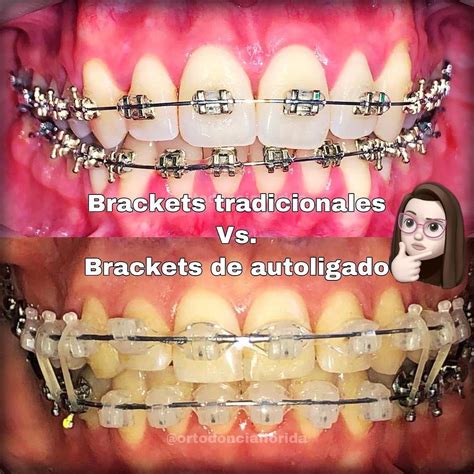 brackets metalicos vs autoligables|ortodoncia y brackets.